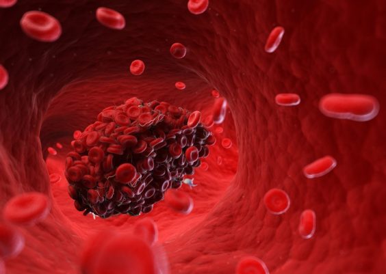 What Causes Blood Clots? 11 Things That Can Raise Your Risk